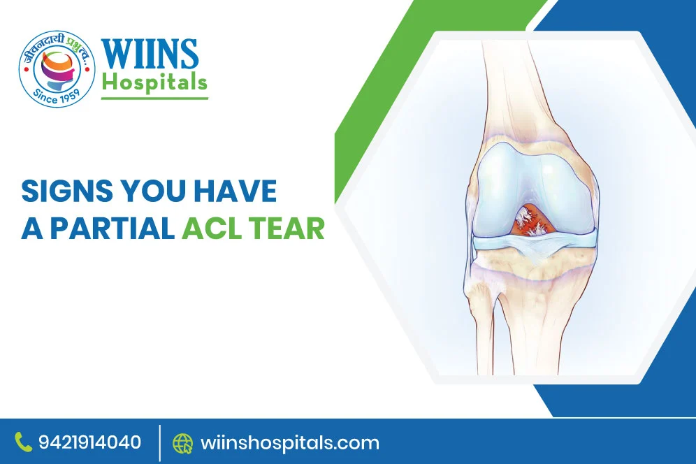 Signs You Have A Partial ACL Tear