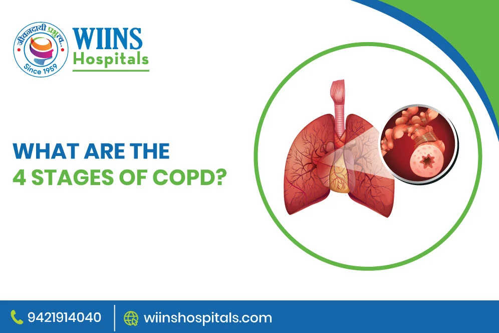 What Are the 4 Stages of COPD?