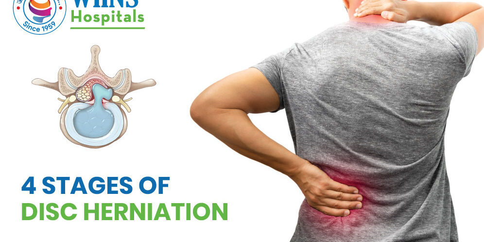 4 Stages of Disc Herniation