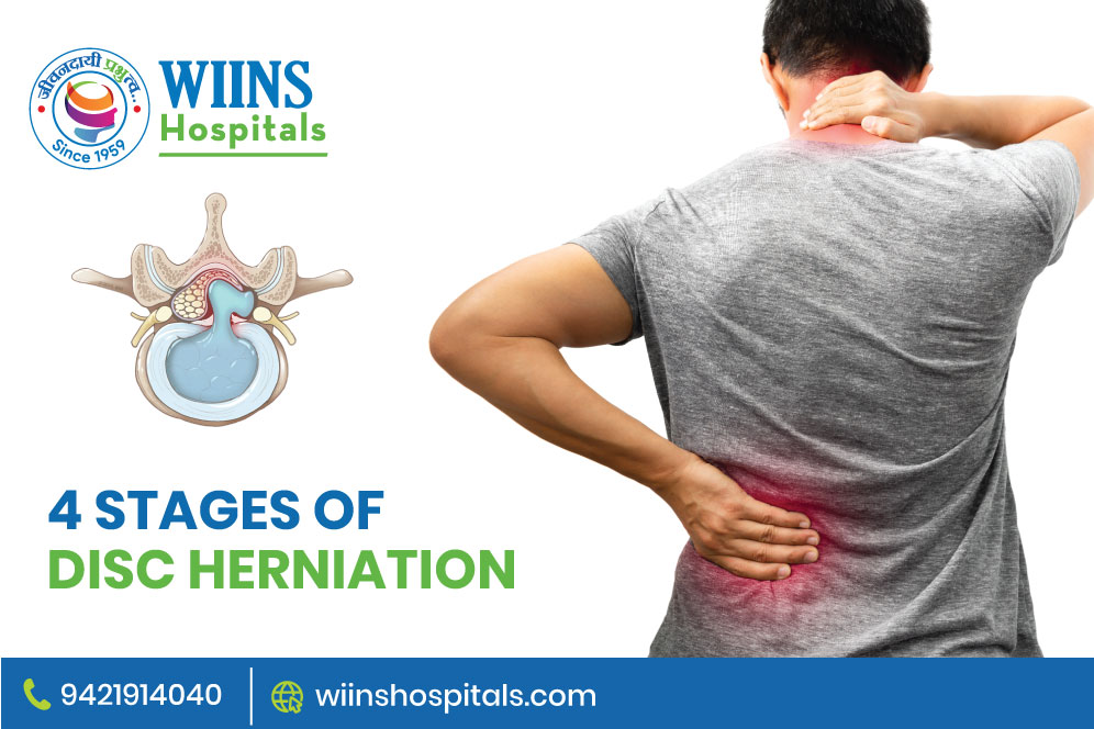 4 Stages of Disc Herniation