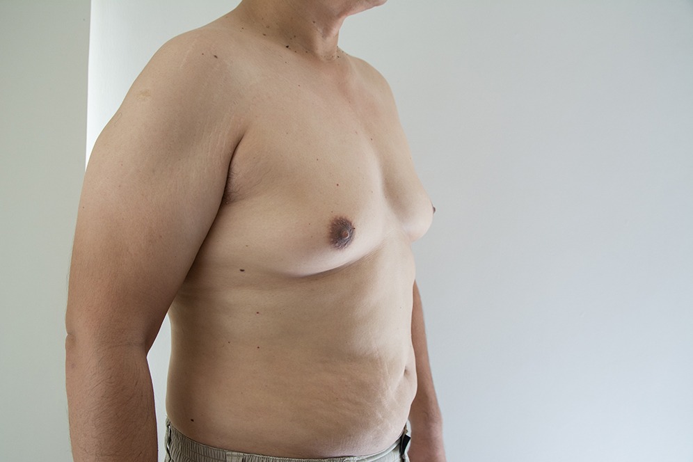 Gynecomastia Surgery A Journey To A More Confident You