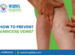 How to Prevent Varicose Veins