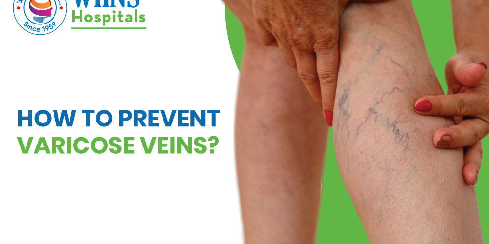 How to Prevent Varicose Veins