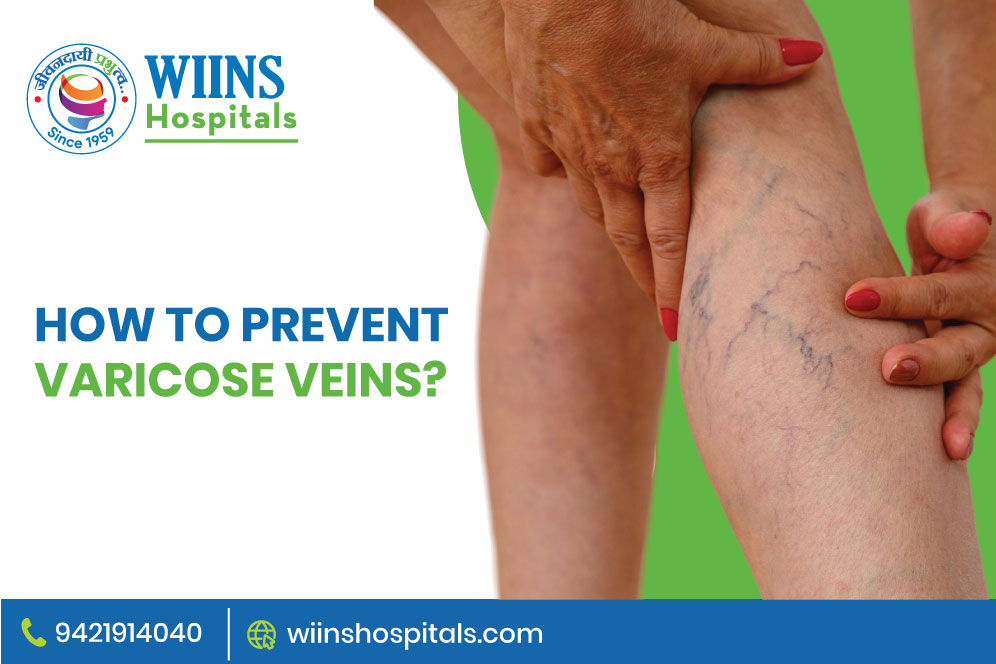 How to Prevent Varicose Veins