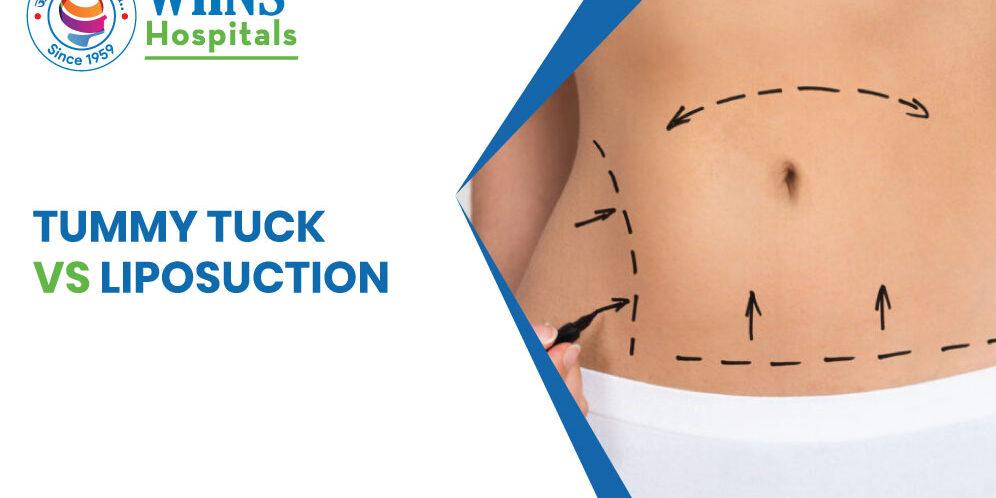 Tummy Tuck vs Liposuction
