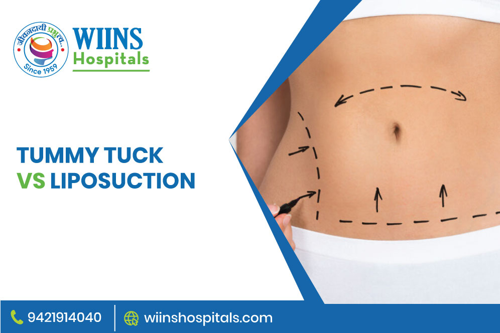 Tummy Tuck vs Liposuction
