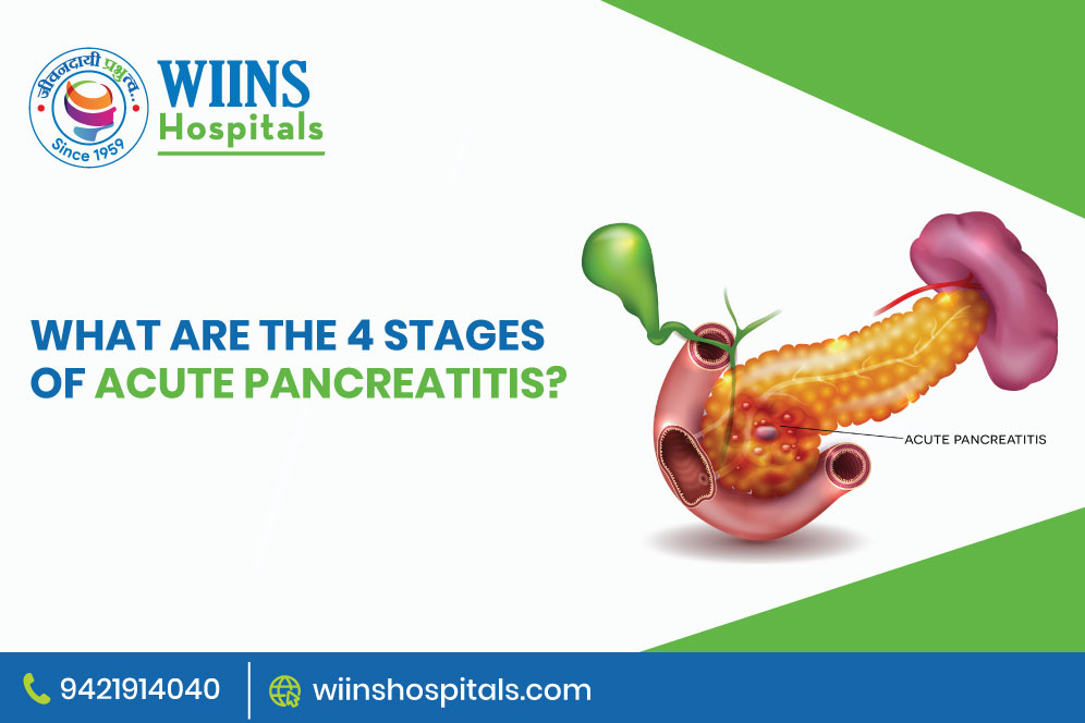 What are the 4 stages of acute pancreatitis