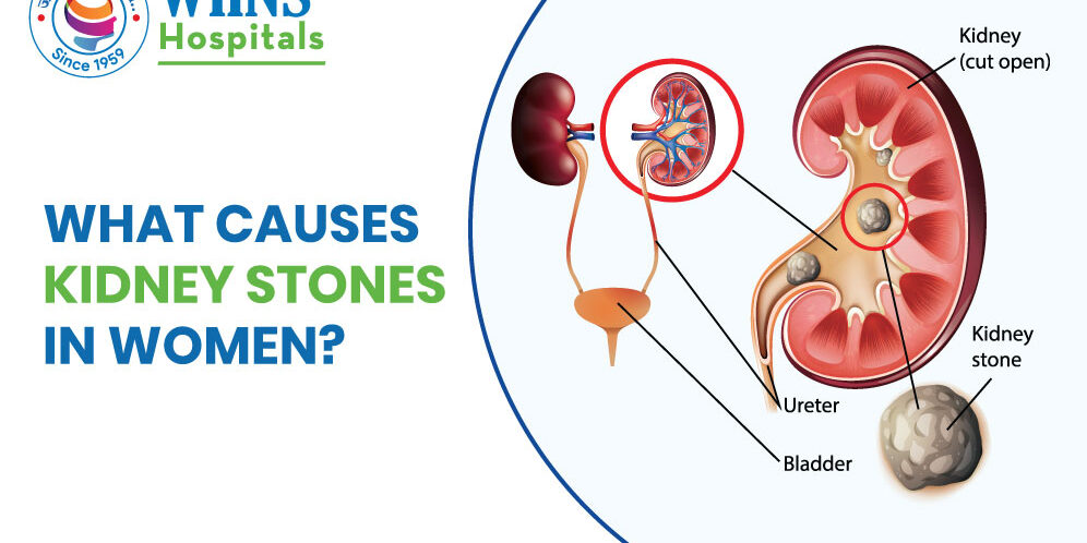 What causes kidney stones in women