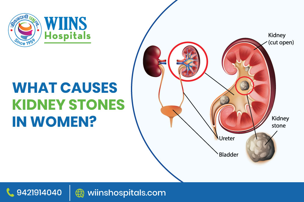 What causes kidney stones in women