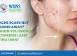 Acne Scars Not Going Away? When You Should Consider Laser Treatment