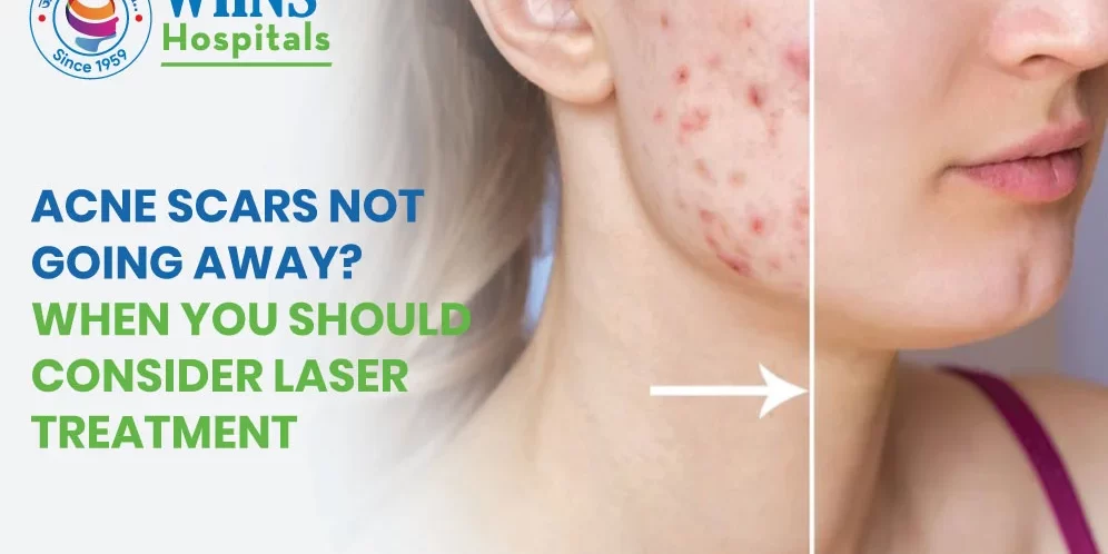 Acne Scars Not Going Away? When You Should Consider Laser Treatment
