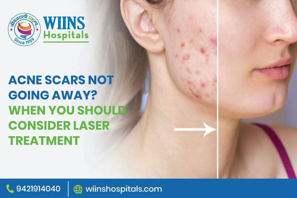 Acne Scars Not Going Away? When You Should Consider Laser Treatment
