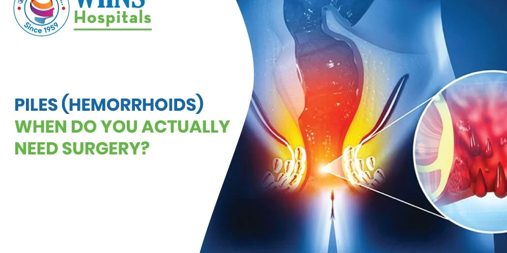 Piles (Hemorrhoids): When Do You Actually Need Surgery?