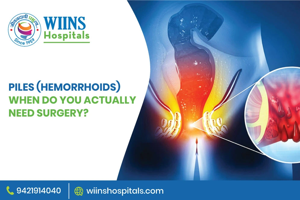 Piles (Hemorrhoids): When Do You Actually Need Surgery?