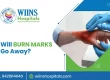Will Burn Marks Go Away