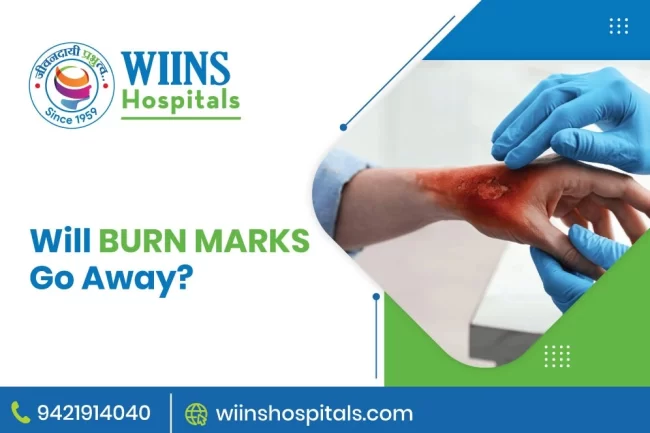 Will Burn Marks Go Away
