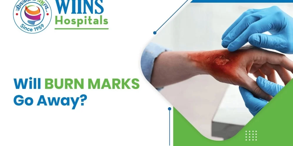 Will Burn Marks Go Away Will Burn Marks Go Away