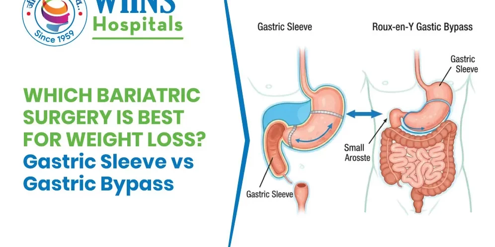 Which Bariatric Surgery Is Best for Weight Loss? Gastric Sleeve vs Gastric Bypass Which Bariatric Surgery Is Best for Weight Loss? Gastric Sleeve vs Gastric Bypass