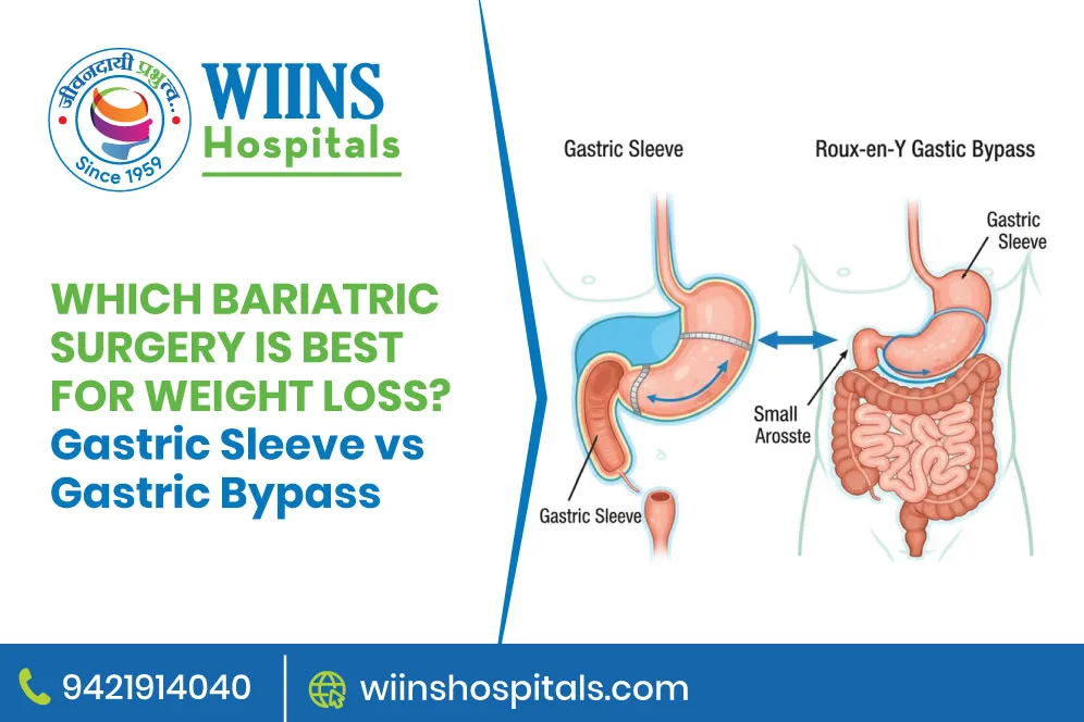 Which Bariatric Surgery Is Best for Weight Loss? Gastric Sleeve vs Gastric Bypass