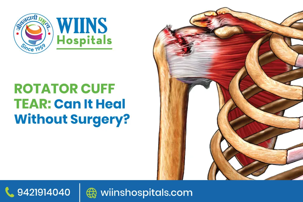 Rotator Cuff Tear: Can It Heal Without Surgery?