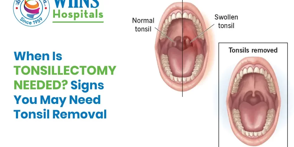When Is Tonsillectomy Needed? Signs You May Need Tonsil Removal When Is Tonsillectomy Needed? Signs You May Need Tonsil Removal