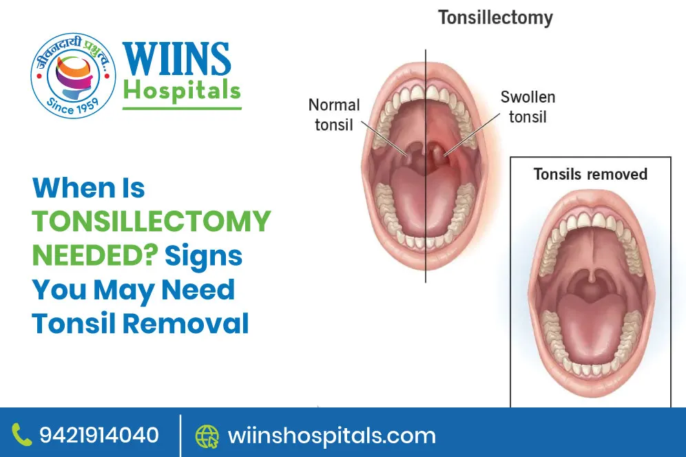 When Is Tonsillectomy Needed? Signs You May Need Tonsil Removal